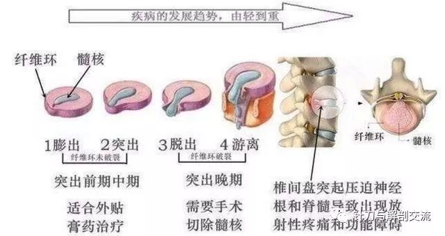 腰椎间盘突出最新疗法研究与应用进展